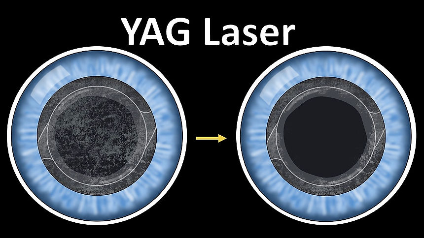 YAG Capsulotomy
